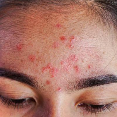 Kulit Berjerawat? Jangan Asal Pilih Suncare. Ini Tips Nya